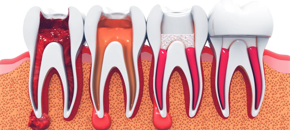 Root Canal Treatment in Thane